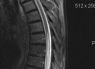 Syrinx Thoracic MRI Sagittal